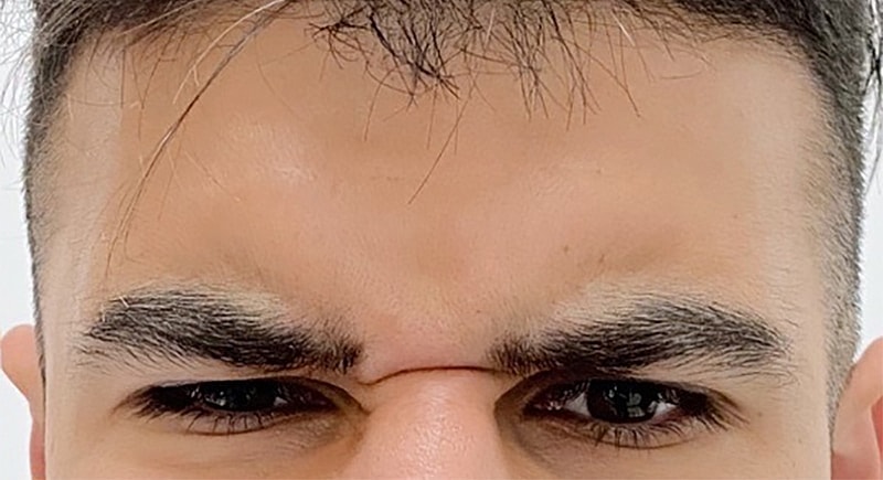 Botox Before & After