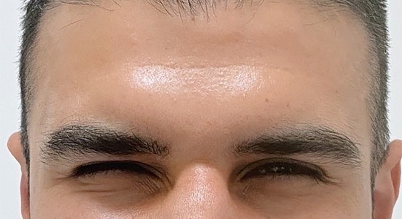 Botox Before & After