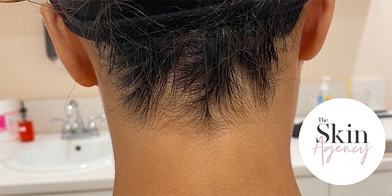 Laser Hair Removal Before & After
